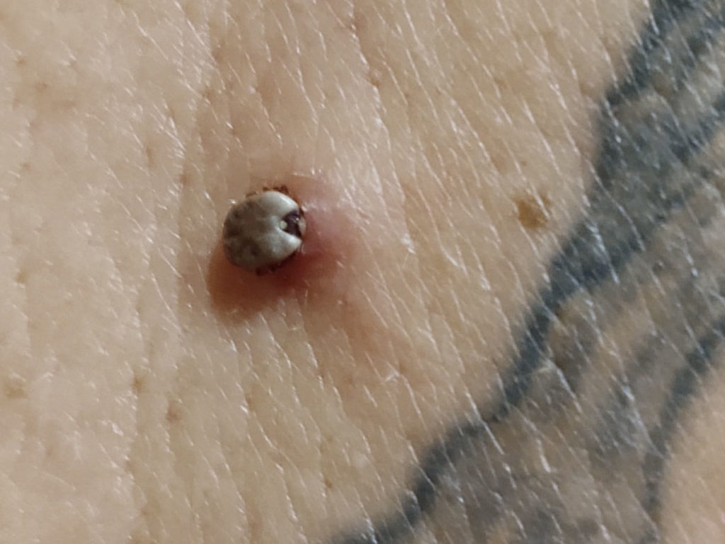 what a tick bite looks like on a human