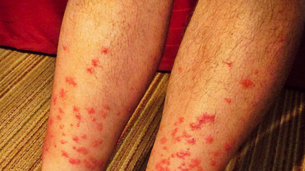 how to avoid chiggers while camping